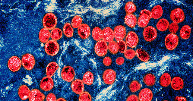 Cepa grave del virus de la viruela del simio detectada en Los Ángeles